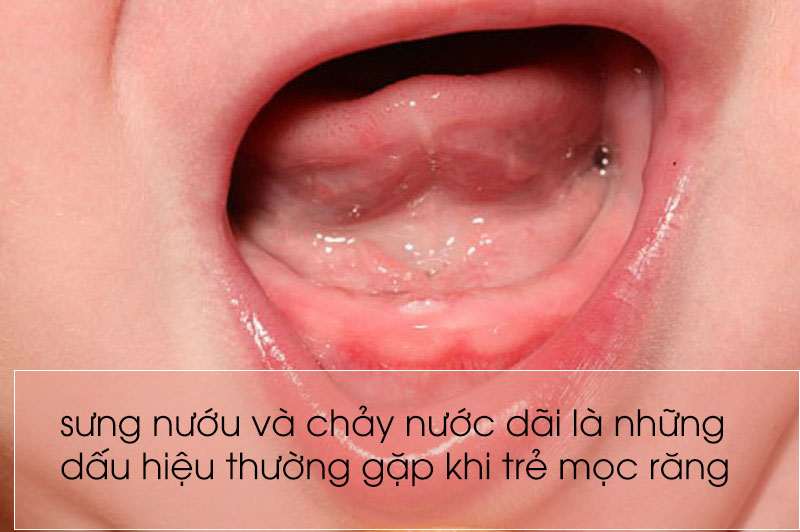 1 Cái Răng Mọc Trong Bao Lâu? Gallery 1
