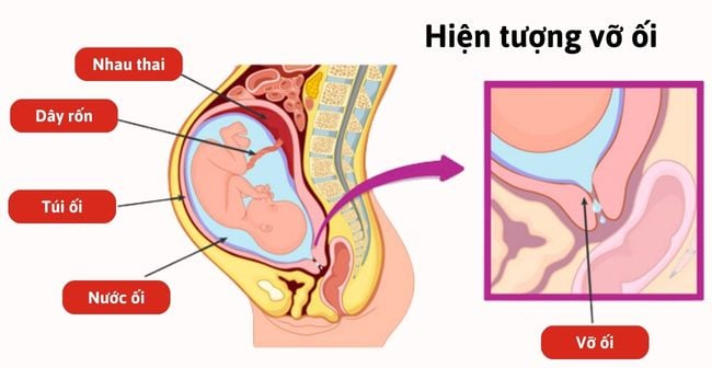 Vỡ Nước Ôi Bao Lâu Thì Đẻ? Gallery 1