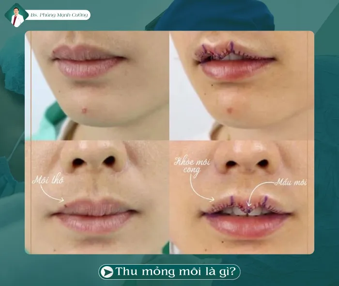 Thu gọn môi dày
