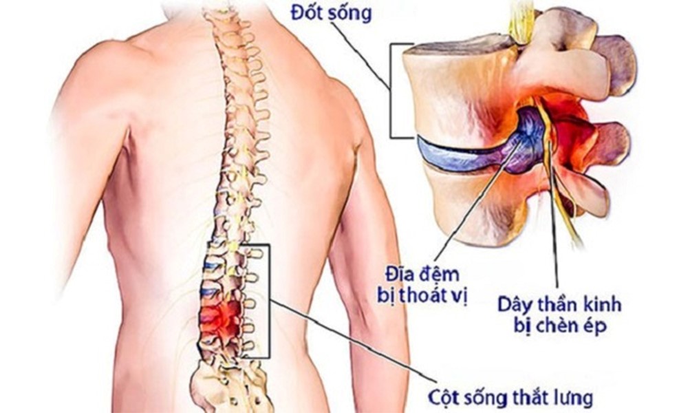 Thuốc Trị Cụp Xương Sống Gallery 2