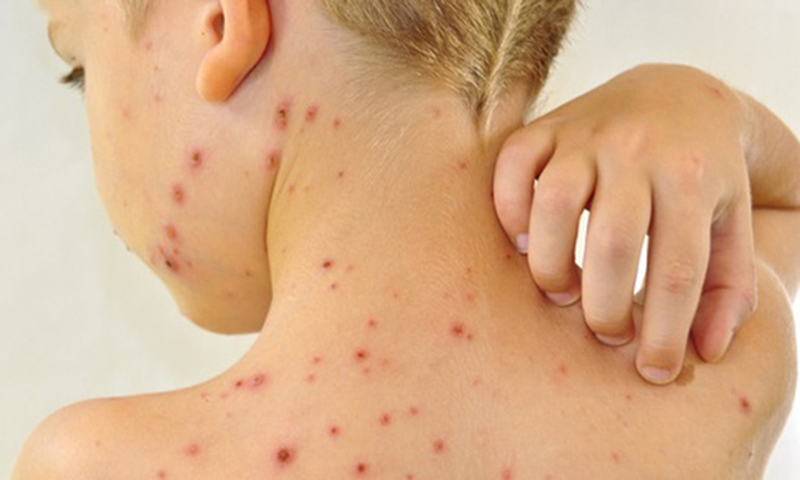 Thủy đậu có ngứa không?