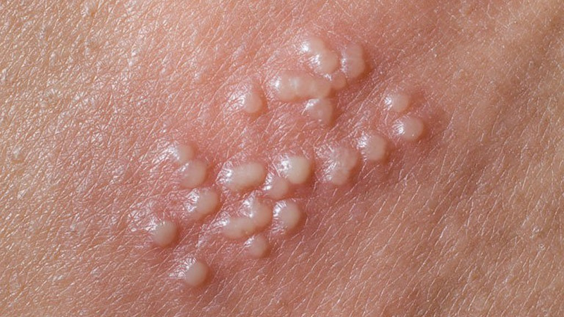 Thủy đậu mọc ở vùng kín: Nguyên nhân, triệu chứng và cách điều trị