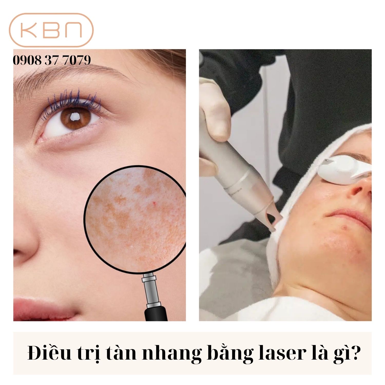 Bắn tàn nhang bao nhiêu tiền? Gallery 2