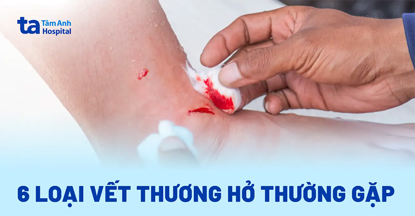 Cô bạn cùng lớp trên mình đầy vết thương: Nguyên nhân và cách giúp đỡ