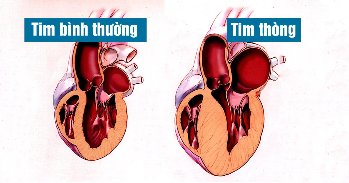 Tim thòng là gì?