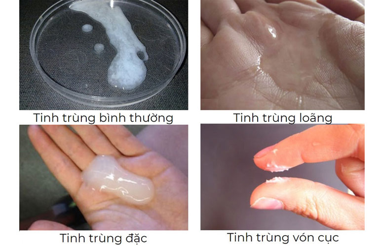 Tinh trùng đặc và loãng: Nguyên nhân, triệu chứng và cách khắc phục