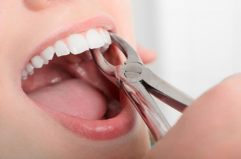 Tới Tháng Có Nhổ Răng Được Không?