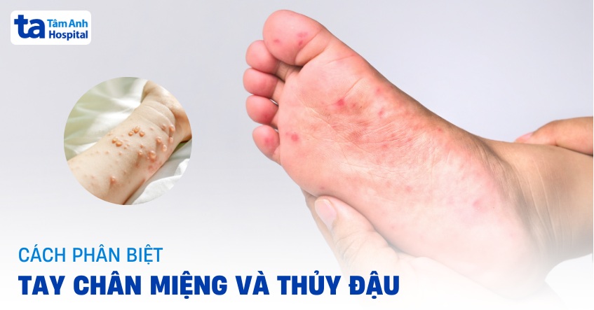 Phân biệt Tay Chân Miệng và Thủy Đậu Gallery 2