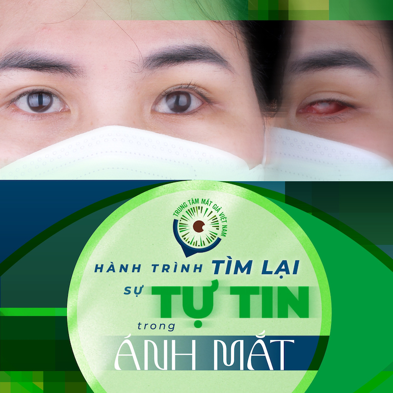Trống mắt hay Chống mắt? Gallery 2