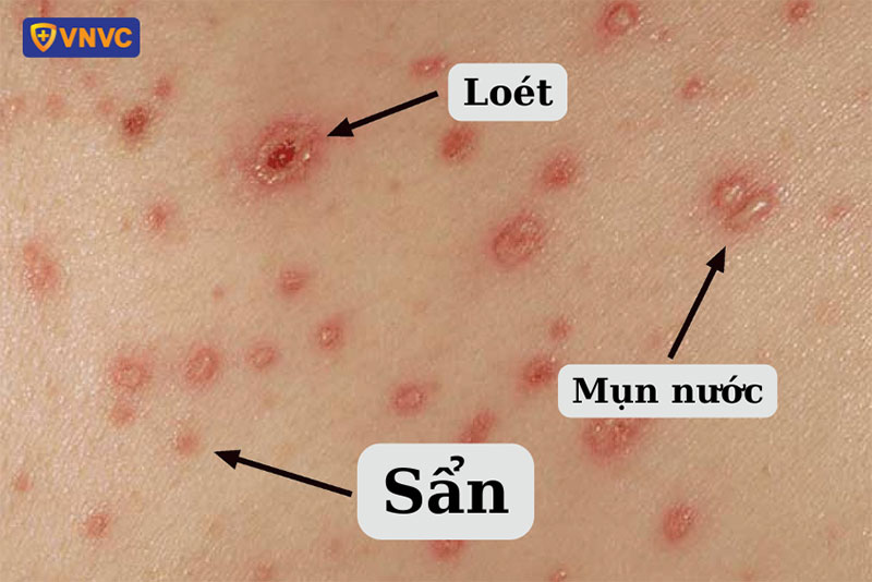 Trái Rạ Là Bệnh Gì?