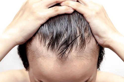 Trán cao có bị hói không?