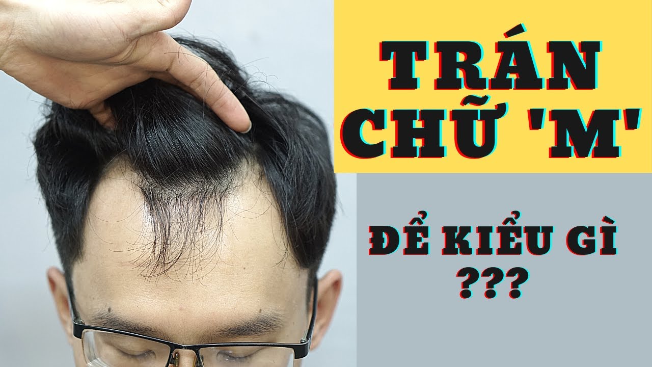 Trán chữ M nam để tóc gì? Gallery 2