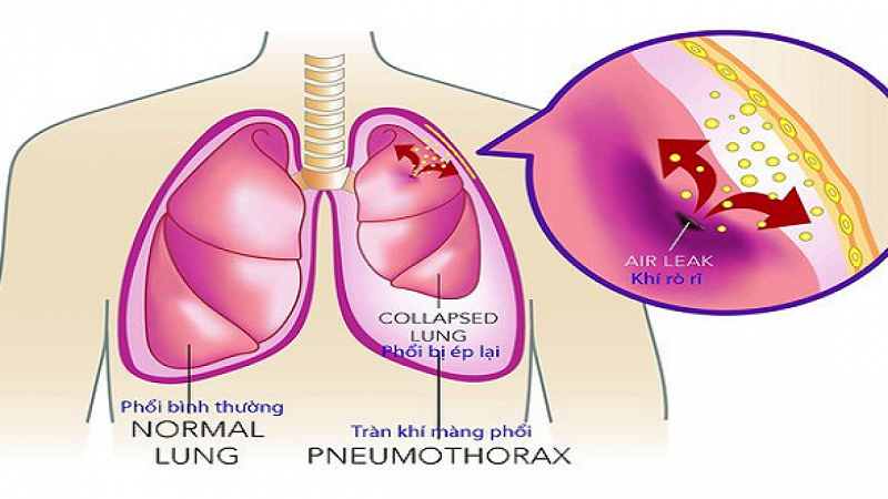 Tràn khí màng phổi có nguy hiểm không?