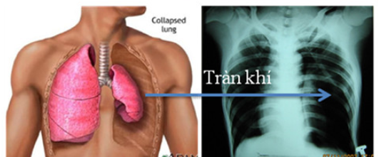 Tràn khí màng phổi có nguy hiểm không? Gallery 1