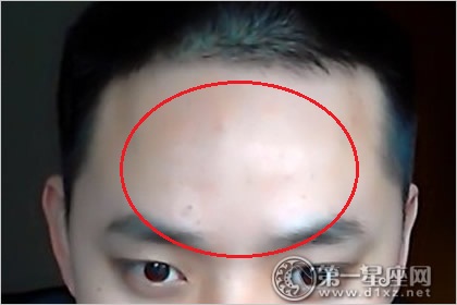 Trán Phục Tê Cốt Là Gì?
