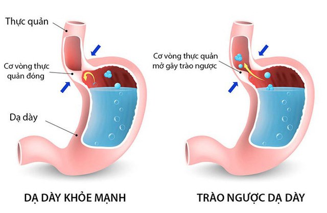 Trào ngược dạ dày: Nguyên nhân, triệu chứng và cách điều trị