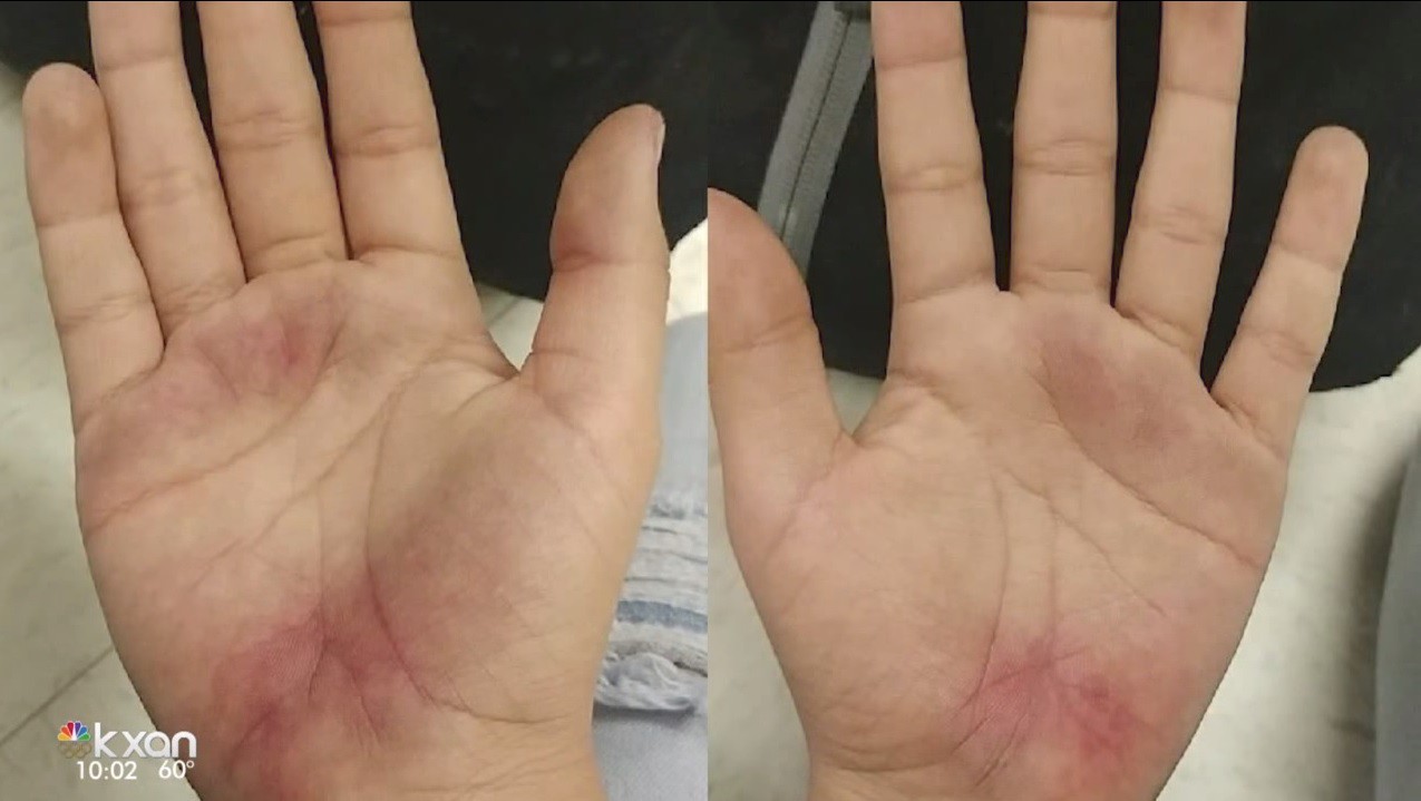 Trầy Xước: Nguyên Nhân, Cách Điều Trị và Phòng Ngừa