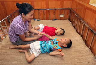 Trẻ bị bại não sống được bao lâu? Gallery 2