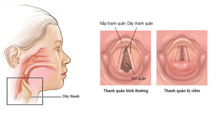 Trẻ bị khản tiếng phải làm sao?