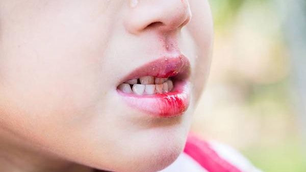Trẻ bị ngã rách môi trong: Cách xử trí và phòng ngừa