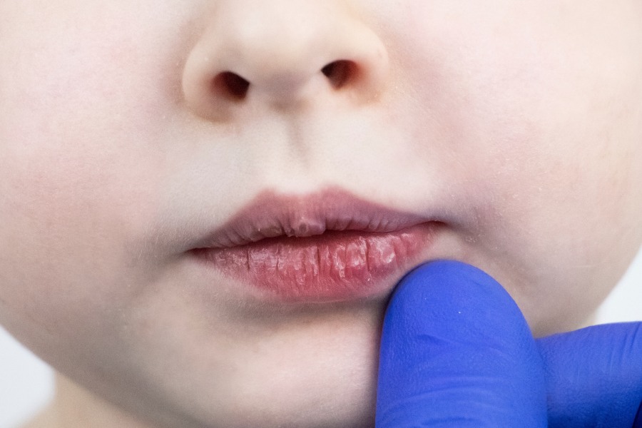 Trẻ bị thâm viền môi: Nguyên nhân và cách khắc phục
