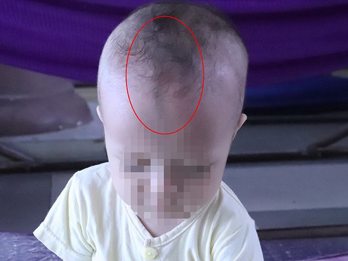 Trẻ Có Đường Dọc Giữa Trán: Nguyên Nhân và Điều Cần Biết