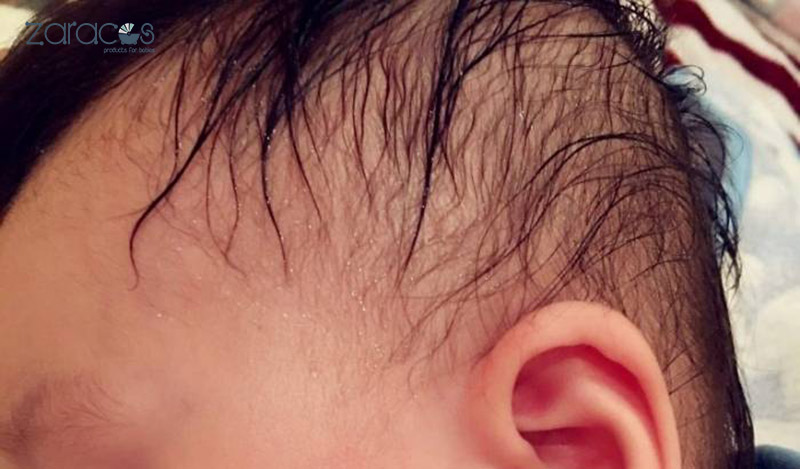 Trẻ Ra Mồ Hôi Trộm Ở Đầu Khi Ngủ: Nguyên Nhân Và Cách Khắc Phục
