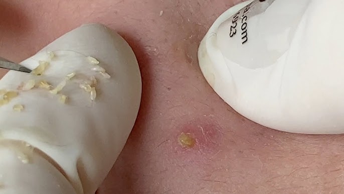 Hidden Acne: Causes, Treatment, and Prevention Gallery 2