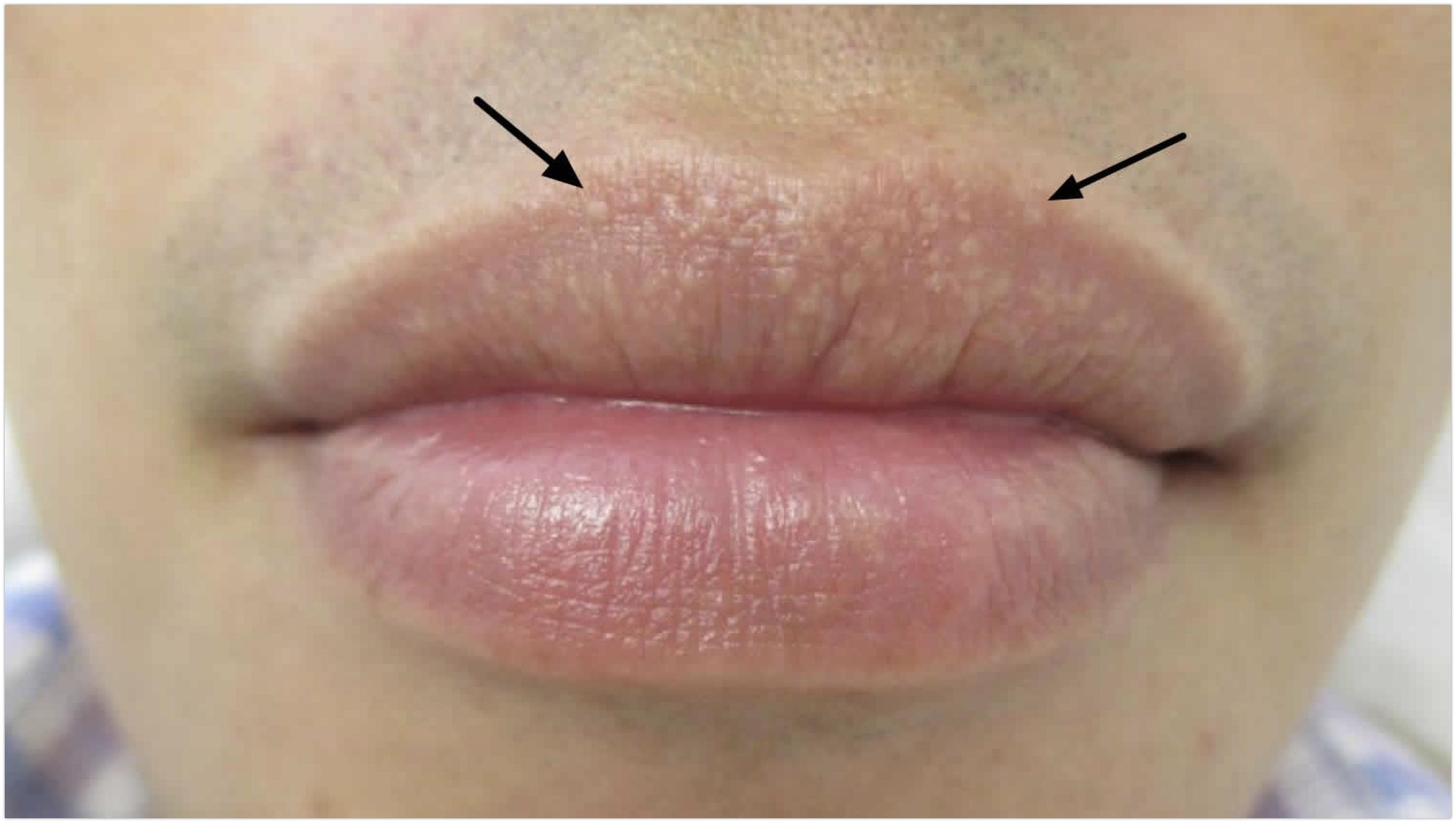 Trên môi có đốm trắng là bệnh gì?