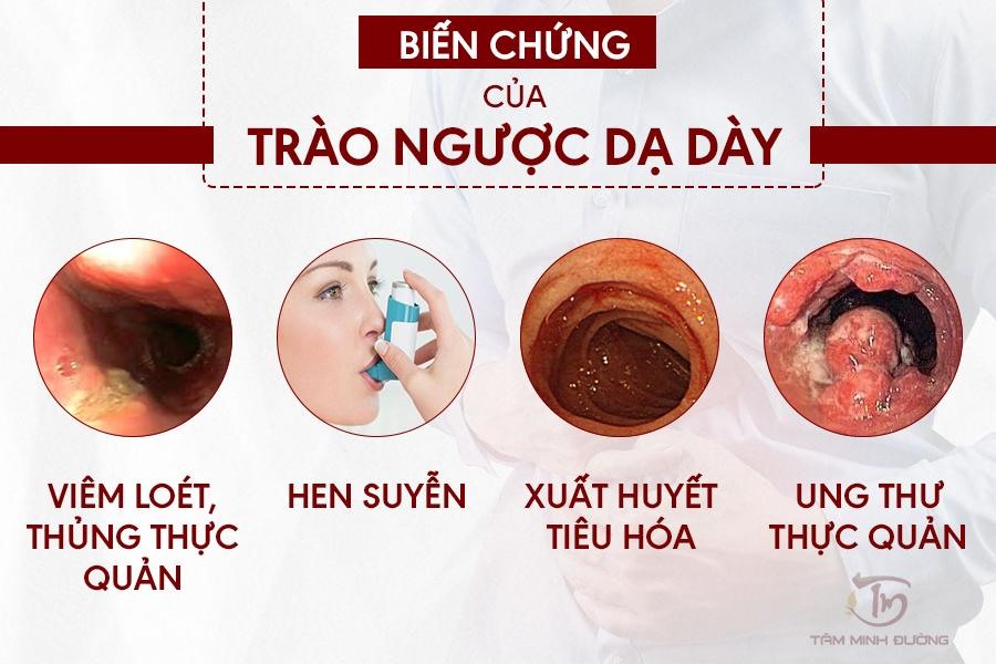 Trị Dứt Điểm Trào Ngược Dạ Dày
