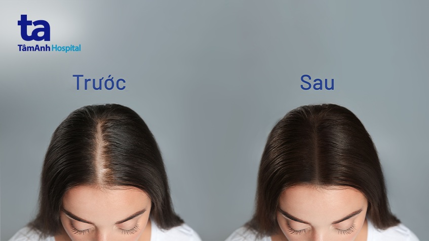 Trị Hói Đỉnh Đầu Hiệu Quả - Phương Pháp Và Lời Khuyên