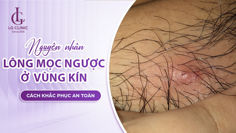 Trị Lông Mọc Ngược Ở Vùng Kín
