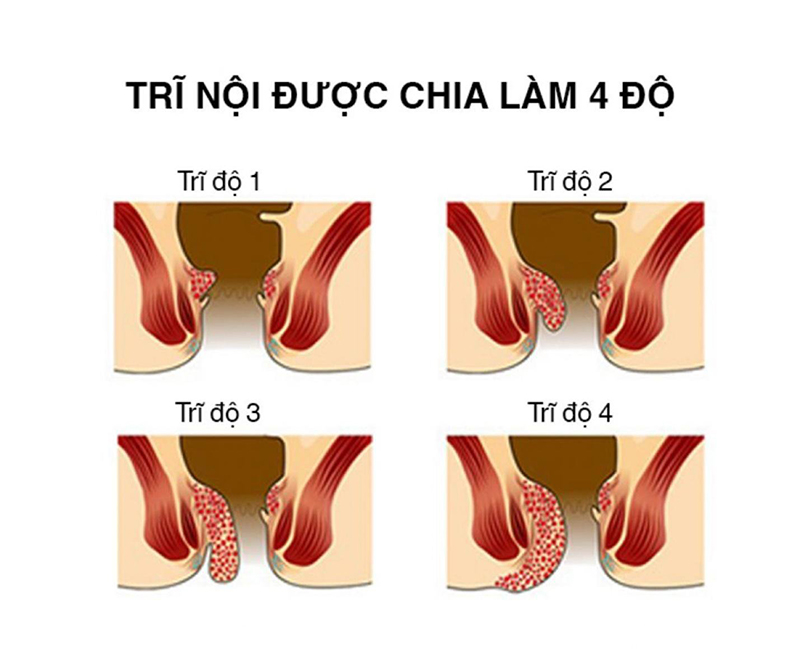 Trĩ Nội Như Thế Nào?