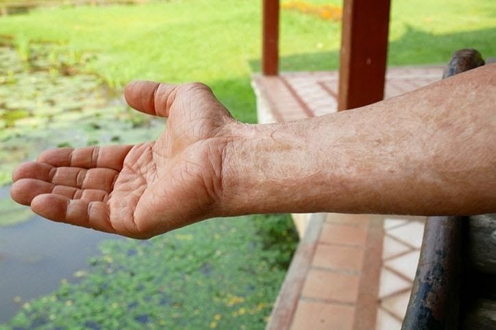 Trị Sẹo Bỏng Nước Sôi Lâu Năm