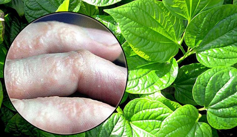 Trị Tổ Đỉa Tại Nhà Hiệu Quả