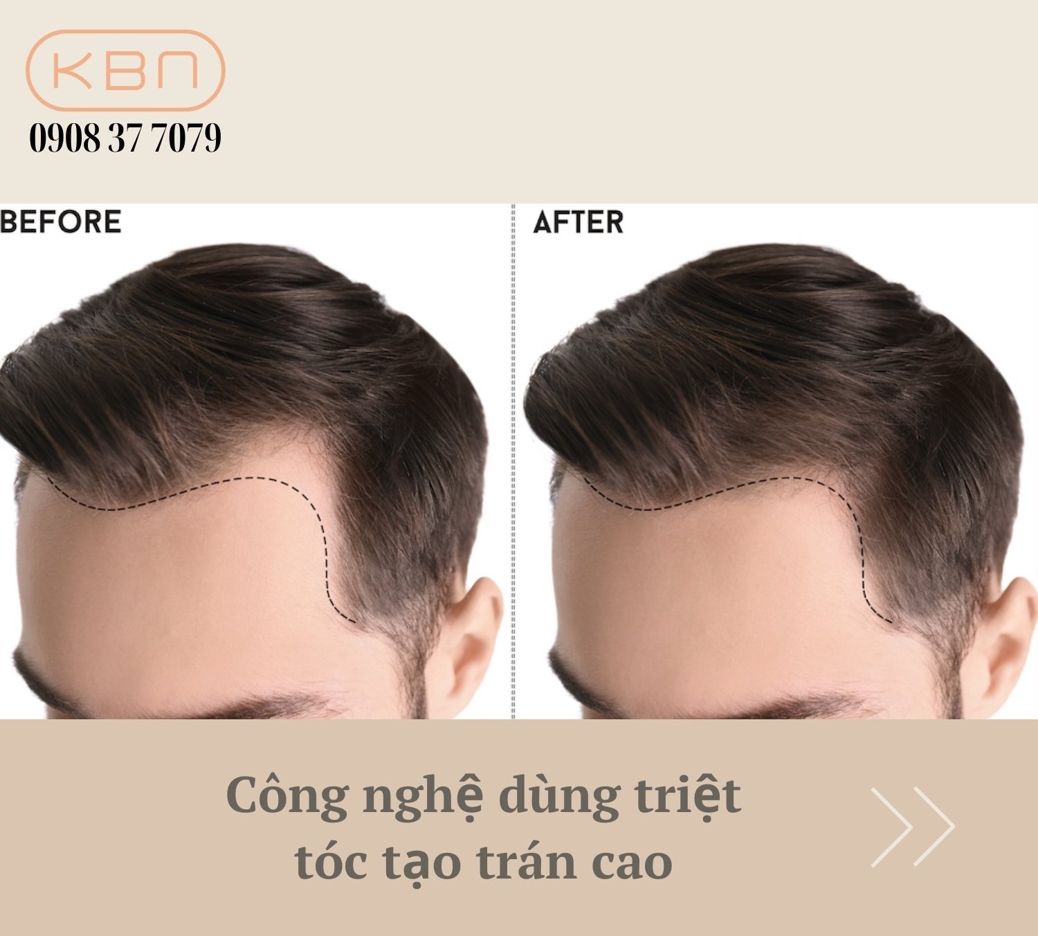 Triệt Tóc Tạo Trán Cao: Hướng Dẫn Chi Tiết & An Toàn