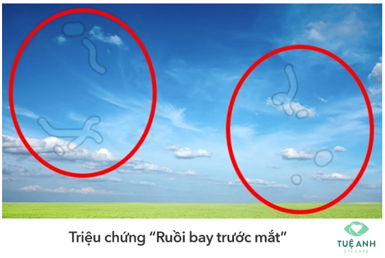Bong võng mạc là gì? Gallery 2