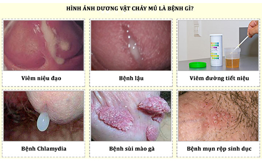 Chảy mủ ở bộ phận sinh dục nam: Nguyên nhân, triệu chứng và cách điều trị Gallery 2