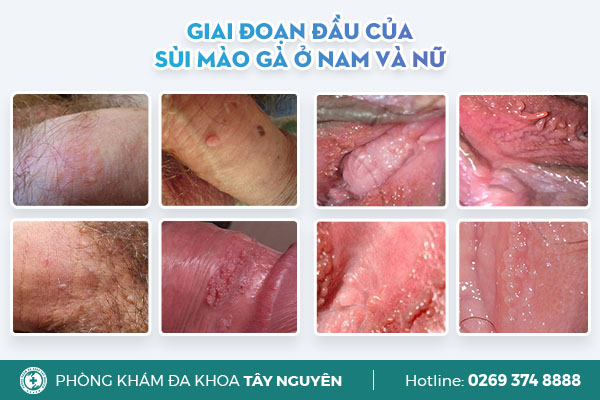 Sùi mào gà là gì? Gallery 2