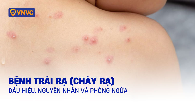 Trái Rạ Là Bệnh Gì? Gallery 1
