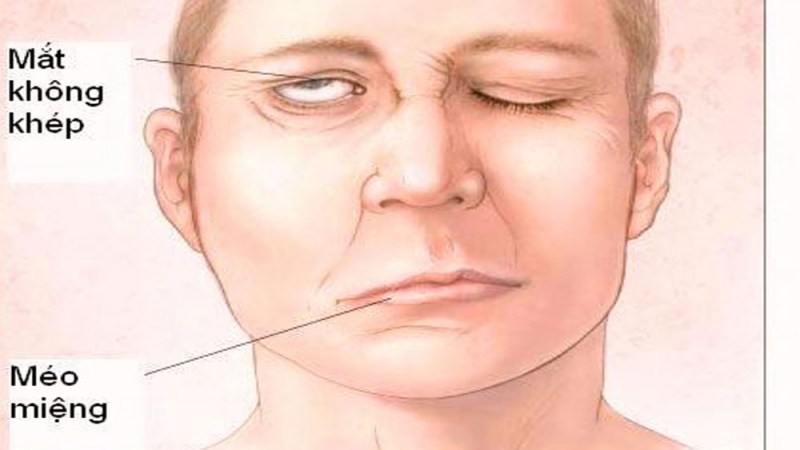 Bị Méo Miệng Nhẹ: Nguyên Nhân, Triệu Chứng và Cách Khắc Phục Gallery 2