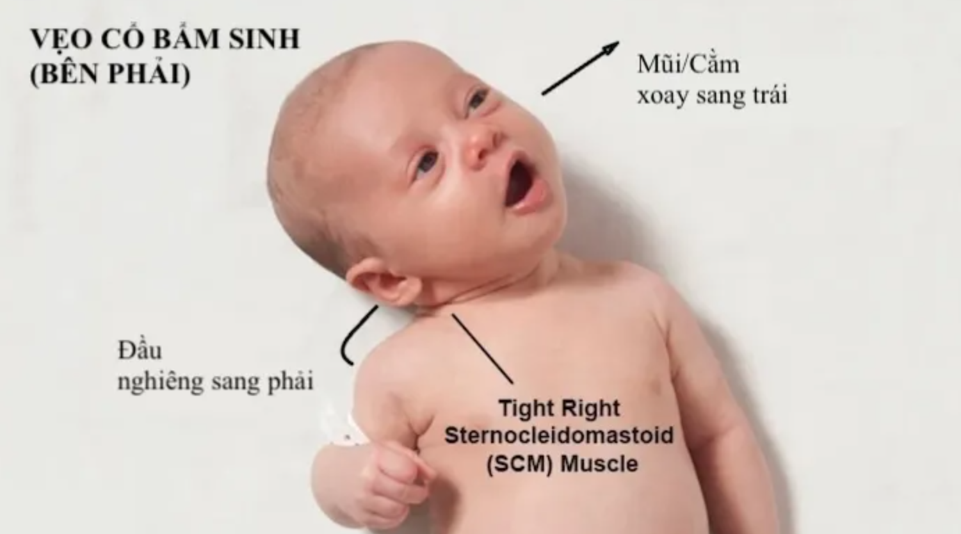 Ngoẹo Cổ: Nguyên Nhân, Triệu Chứng Và Cách Điều Trị Gallery 2