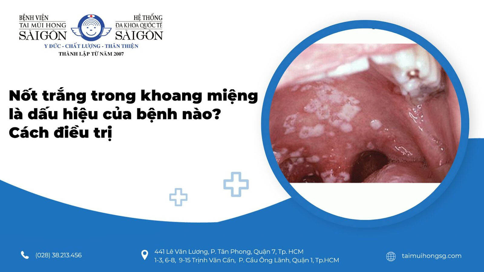Đốm Trắng Trong Miệng: Nguyên Nhân, Triệu Chứng Và Cách Điều Trị Gallery 2