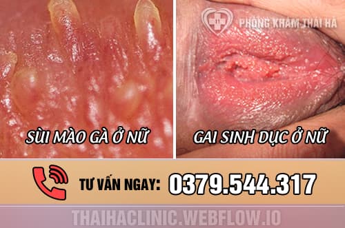 Gai Sinh Dục Bị Ngứa: Nguyên Nhân Và Cách Điều Trị Gallery 2