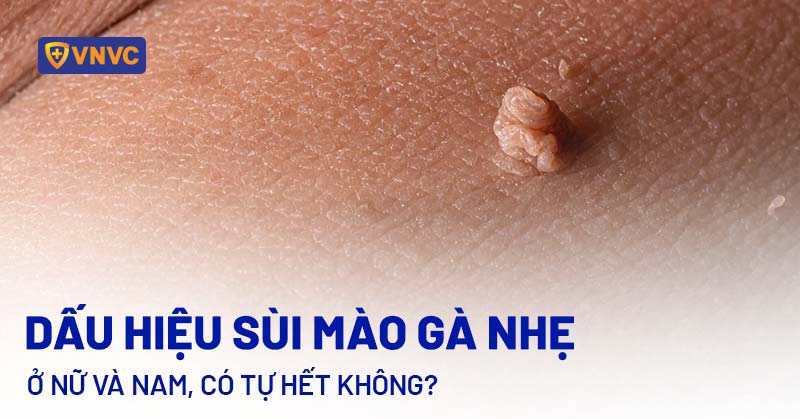 Gai Việt Sau Hàng: Nguyên Nhân, Triệu Chứng Và Cách Điều Trị Gallery 2