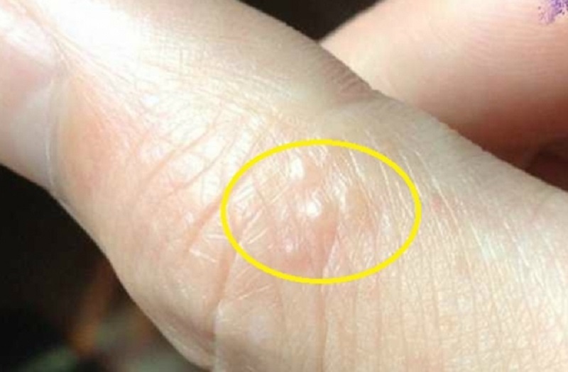 Bị ghẻ nước phải làm sao? Gallery 2