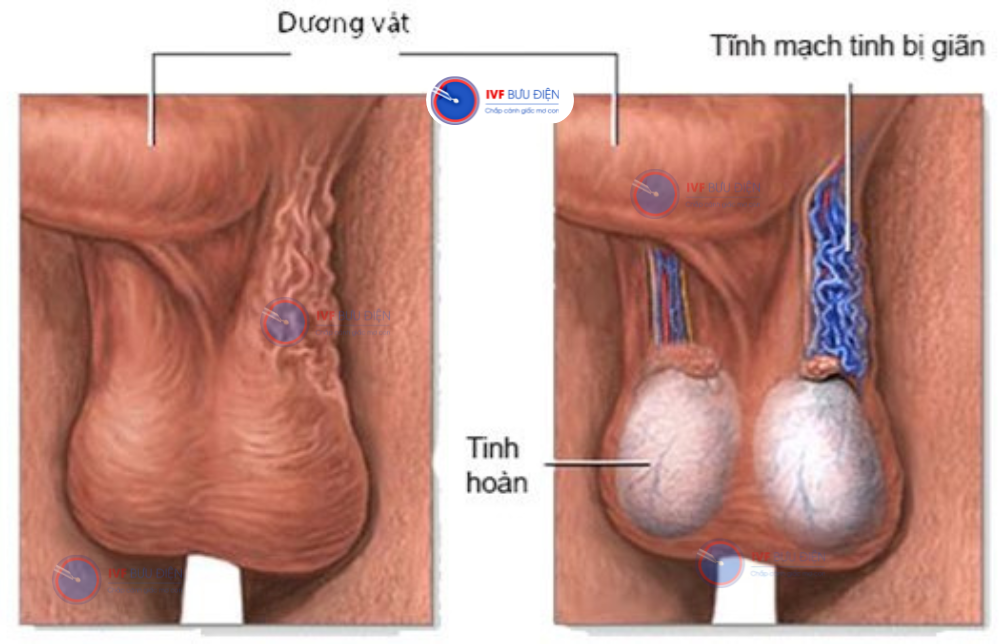 Giãn Thừng Tinh Là Gì? Gallery 2