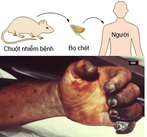 Hạch Chuột Là Gì? Gallery 2