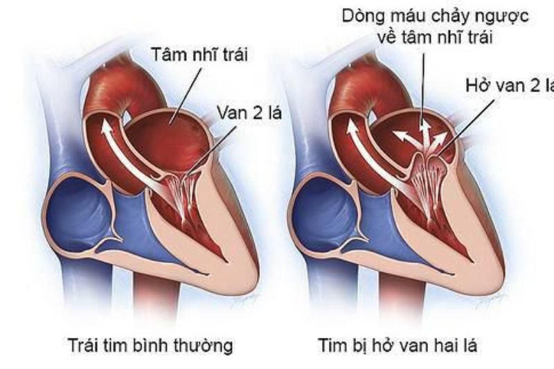 Hở van tim 2 lá 2/4 có nguy hiểm không? Gallery 2
