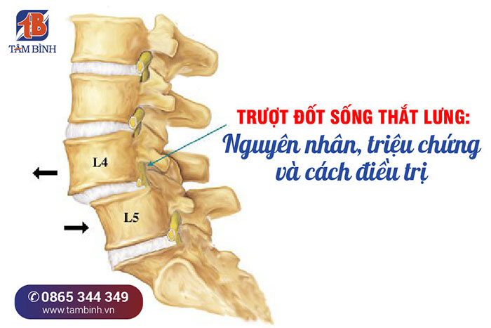 Lệch Đốt Sống Lưng: Nguyên Nhân, Triệu Chứng và Cách Điều Trị Gallery 2
